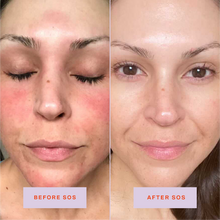 Tower 28 Beauty SOS Daily Rescue Facial Spray Before + After Photo: left side of image (before) shows customer with redness on cheeks, forehead, and chin. Right side (after) of the image shows customer without redness on cheeks, forehead, and chin.