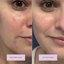 Tower 28 Beauty SOS Daily Rescue Facial Spray Before + After Photo: left side of image (before) shows customer with redness and patchiness on cheeks and chin. Right side (after) of the image shows customer without redness or patchiness on cheeks and chin.