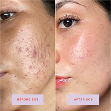 Tower 28 Beauty SOS Daily Rescue Facial Spray Before + After Photo: left side of image (before) shows customer with blemishes and inflammation on cheeks and jaw area. Right side (after) of the image shows customer with reduced blemishes and inflammation on cheeks and jaw area.